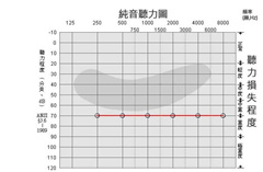 解讀純音(yīn)聽(tīng)力圖