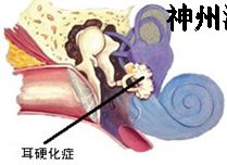 【耳科疾病】耳硬化(huà)症